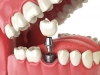 牙齿种植体有哪几种？