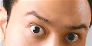 植线双眼皮的手术是什么？什么样的人适合植入双眼皮？