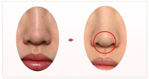 隆鼻后疤痕增生怎么办？隆鼻疤痕怎么解决？