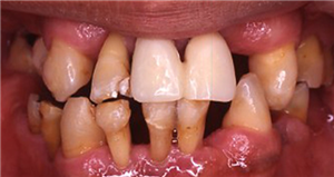 我们是如何形成蛀牙的？如何防止蛀牙？