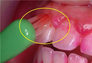 如果蛀牙得不到及时治疗会发生什么？