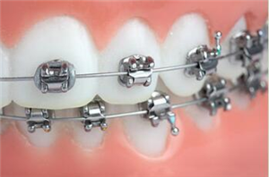修复瓷牙有哪些步骤？