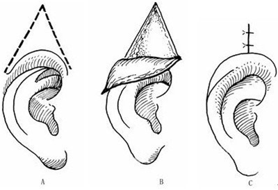 耳朵畸形的年龄要求是什么