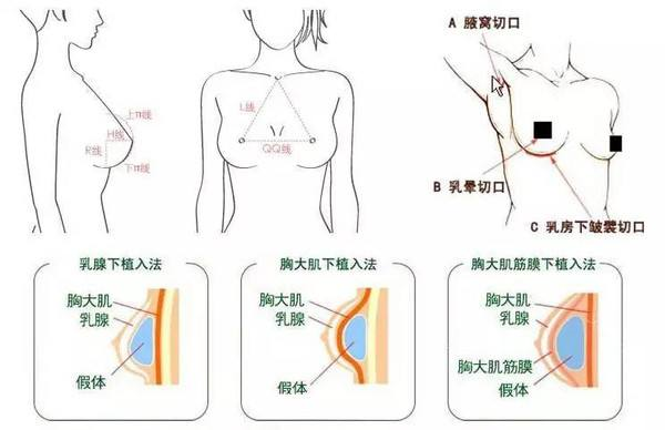 妙桃隆胸的手术过程