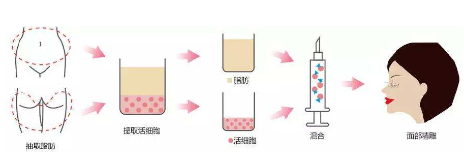 妙桃琴面假体丰胸后怎么按摩