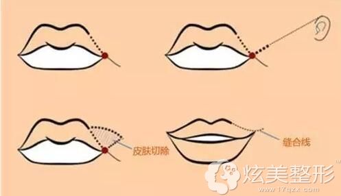 嘴角提升上扬手术过程