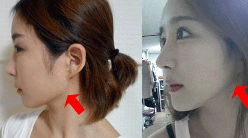 上海磨骨哪家整形医院比较好?