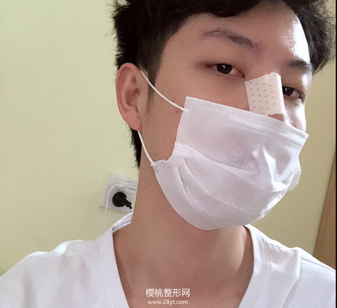 武汉欧尚美王大山隆鼻技术如何?附真人案例+最新价格表一览