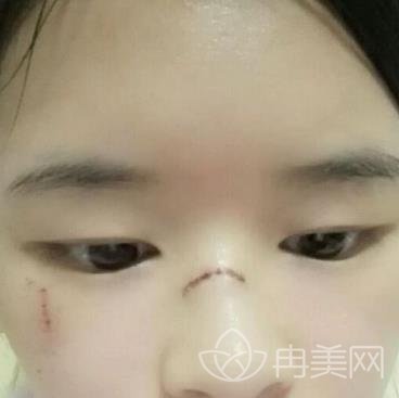 广州南方燕岭医院价格表秋季版本初发布，附祛疤痕效果图