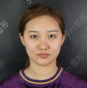 深圳北大医院瘦脸针怎么样？案例和手术恢复实拍图一览