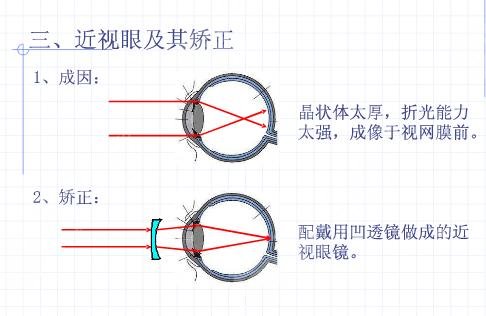 青岛近视眼手术大概多少钱？科普分析，附2021价格表一览！