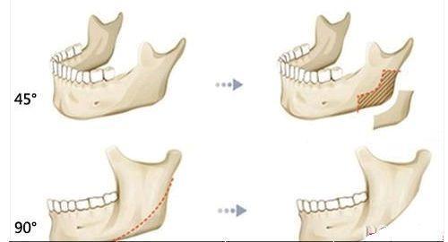 圣嘉新医疗美容医院科普下颌角磨骨