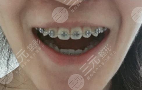 武汉大众口腔医院牙齿矫正案例分享