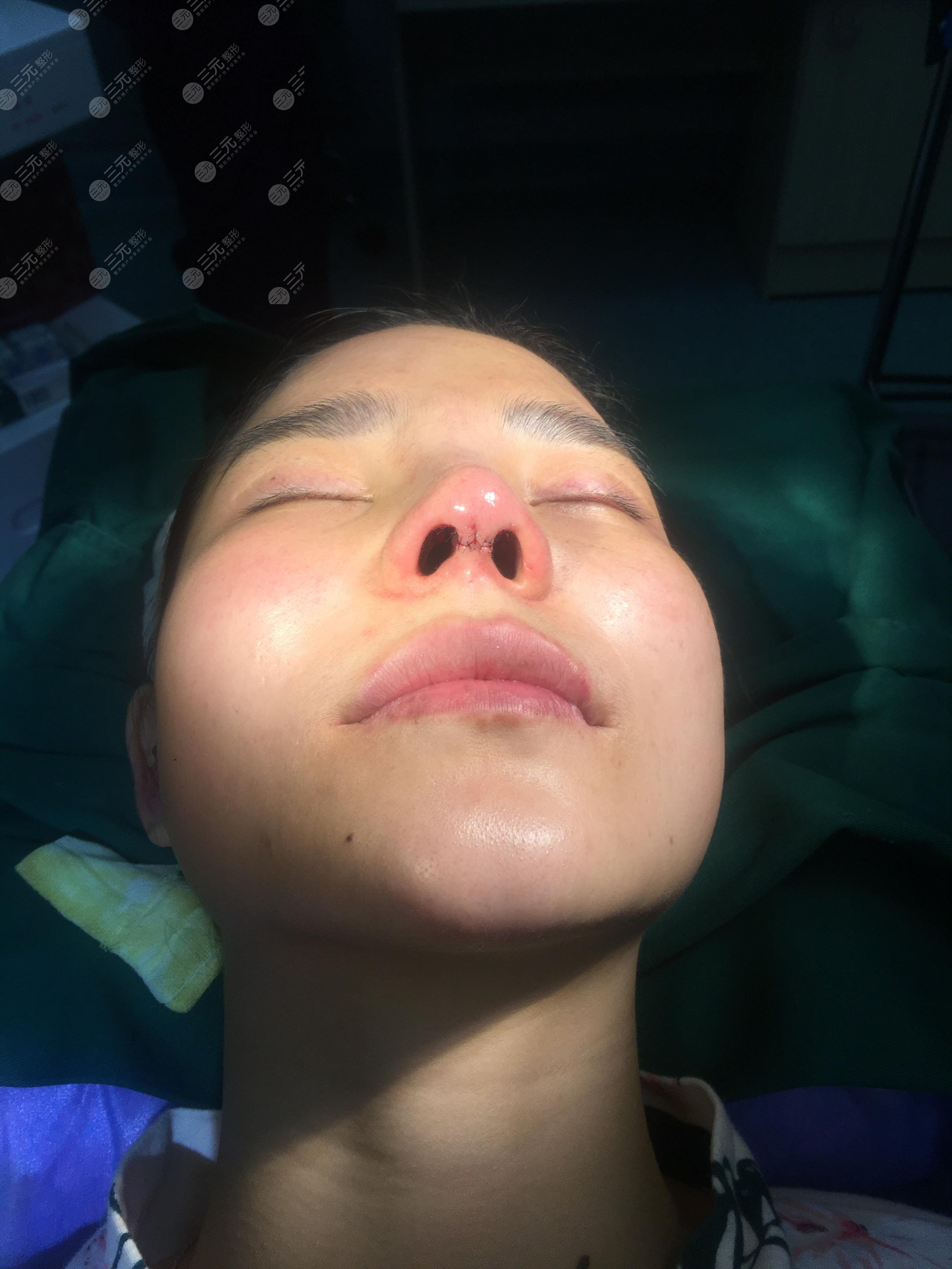 上海市东方医院整形美容中心歪鼻矫正案例：手术中