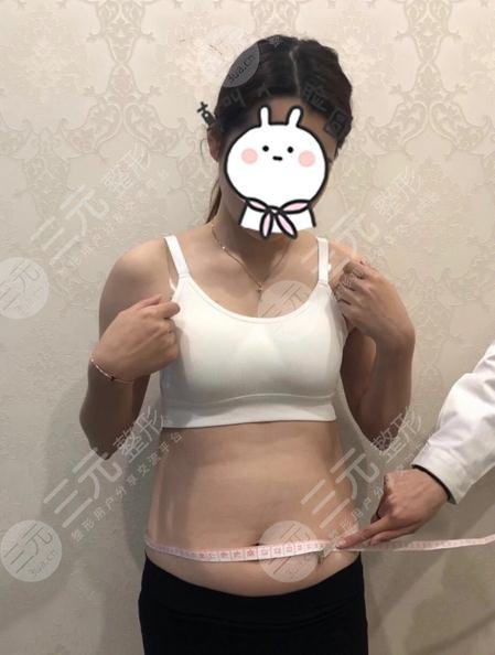 上海市第六人民医院整形科腹部吸脂效果图案例：术前