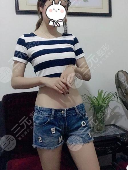 上海长征医院整形外科袁湘斌医生腹部抽脂案例：术后