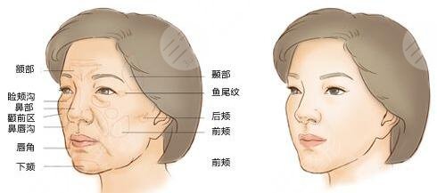 脂肪填充全脸手术的方法
