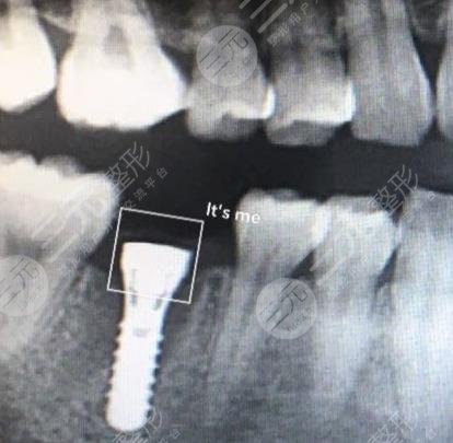 杭州美奥口腔医院种植牙案例分享