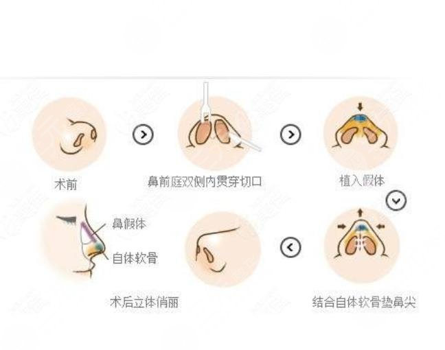 西京医院微整形专家宽鼻矫正的步骤科普