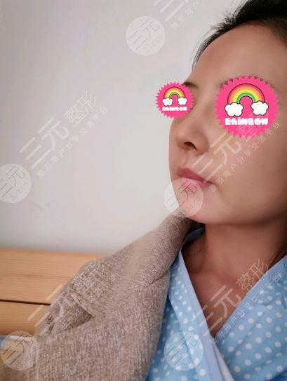 济宁附属医院整形科李鹰医生隆鼻整形案例：术后两周