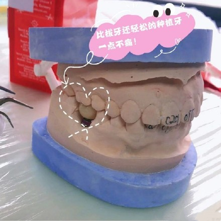 种植牙修复效果图