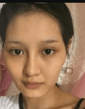 北京自体脂肪填充医院排名,附脂肪填充医生及案例 北京自体脂肪填充医院排名,附脂肪填充医生及案例