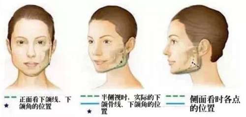 上海九院整形科削骨案例分享.jpg 上海九院整形科削骨案例分享.jpg