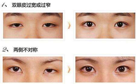 武汉同济医院徐逸割双眼皮案例分享 武汉同济医院徐逸割双眼皮案例分享