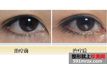 开眼角前后对比图