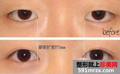开眼角前后对比图