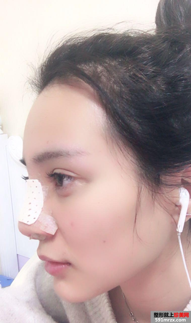 武汉一美整形医院隆鼻怎么样?真实案例分享