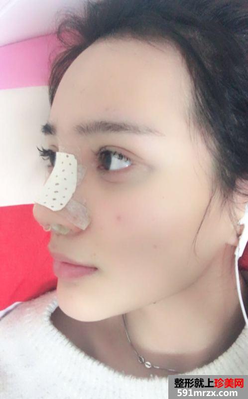 武汉一美整形医院隆鼻怎么样?真实案例分享