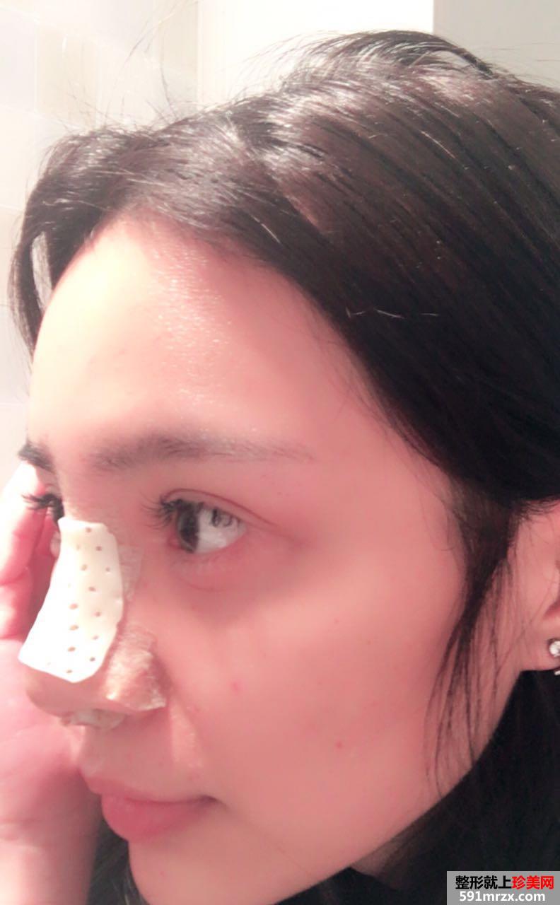 武汉一美整形医院隆鼻怎么样?真实案例分享