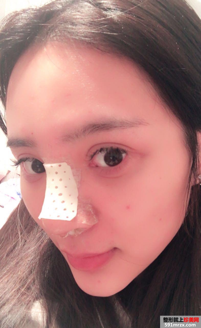 武汉一美整形医院隆鼻怎么样?真实案例分享