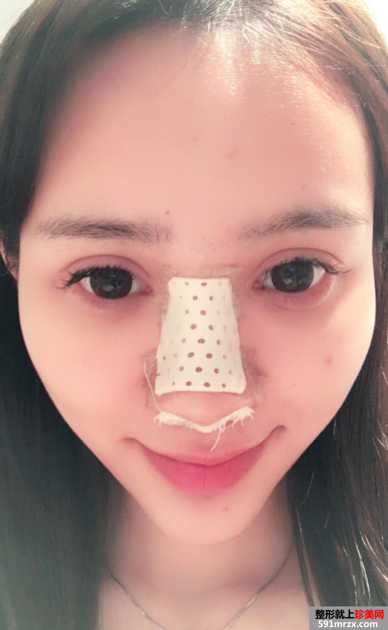 武汉一美整形医院隆鼻怎么样?真实案例分享