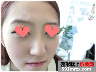 【真人案例】做了玻尿酸填充泪沟，还有前后对比照片哦