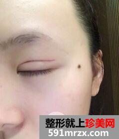 双眼皮手术6