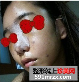 杭州艺星,假体隆鼻价格