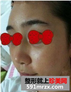 杭州艺星,假体隆鼻价格