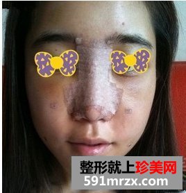 杭州艺星,假体隆鼻价格