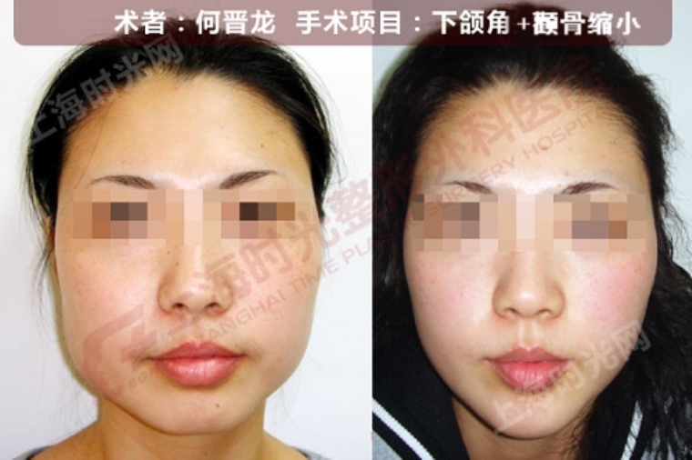 广州哪家改脸型手术效果好呢