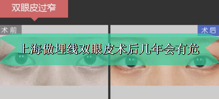上海做埋线双眼皮术后几年会有危害吗