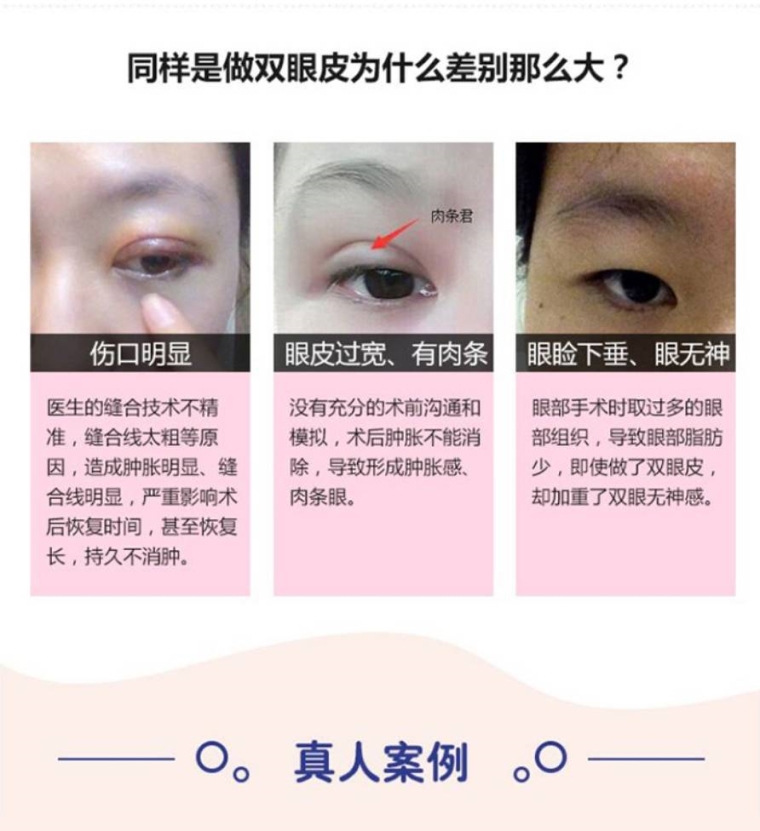 重庆做埋线双眼皮手术维持时间真的很短吗