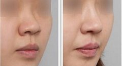 鼻子可以通过哪些方面改善？