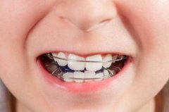 小孩牙齿矫正在几岁较好？