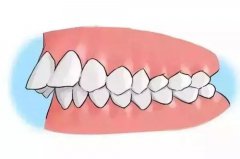 牙齿矫正过程包括哪些？【图解】