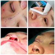 术后鼻孔瘢痕增生是怎么回事？如何可以避免？