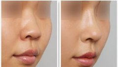 自体脂肪填充对隆鼻的好处和坏处？隆过的鼻子是长期还是半长期？