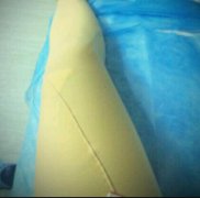 我在广州武警医院做的大腿吸脂，亲身案例分享