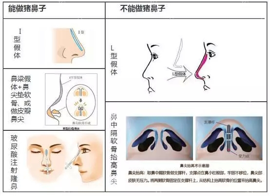隆鼻后不能揉来揉去?